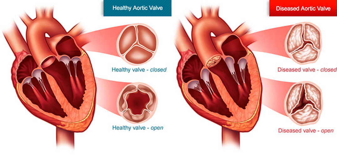 Aortic Stenosis